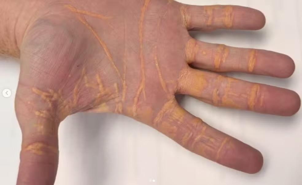 Homem 'vaza' colesterol pelas mãos após aderir a dieta carnívora; FOTOS